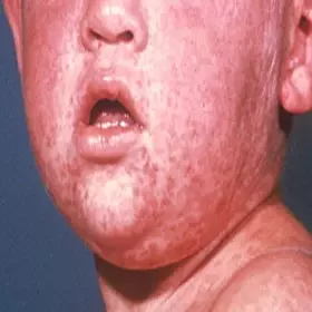 Wysypka u dzieci na twarzy choroba odra