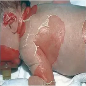 liszajec pęcherzowy noworodków